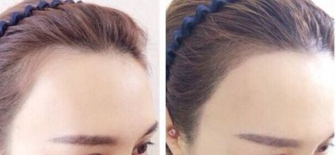 杭州疤痕整形哪家醫(yī)院好？選擇哪個(gè)醫(yī)院更靠譜？