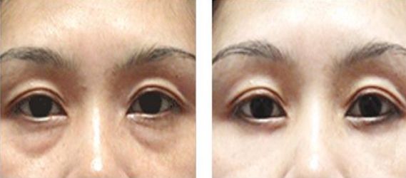 深圳哪家醫(yī)院祛色斑好-四大祛斑療法解密，選擇最適合你的祛斑方式