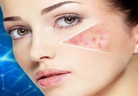 宜賓青春痘治療哪家醫(yī)院效果好？