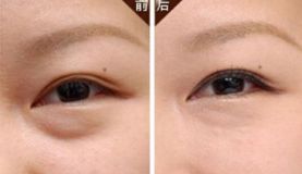 沈陽(yáng)哪家醫(yī)院做脂肪隆胸效果好且價(jià)格合理？