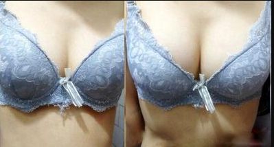 廣州哪家醫(yī)院的乳頭凹陷術效果好？