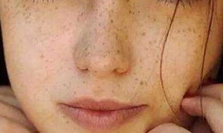 張姣姣的雙眼皮手術(shù)：術(shù)后效果如何？選擇正規(guī)醫(yī)院是關(guān)鍵！