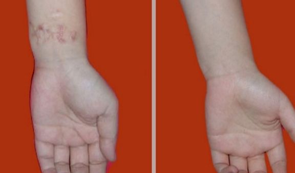 長(zhǎng)沙激光祛痘哪家醫(yī)院好？專(zhuān)業(yè)醫(yī)院推薦及治療經(jīng)驗(yàn)分享