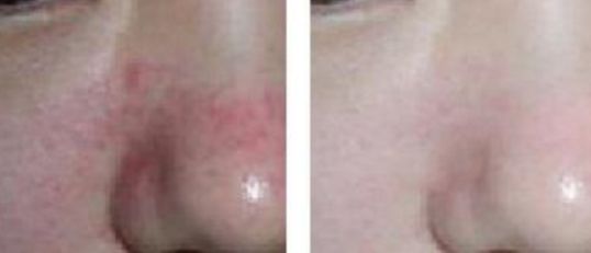 肇慶哪家醫(yī)院激光痣好？最受用戶歡迎的激光痣治療機(jī)構(gòu)有哪些？