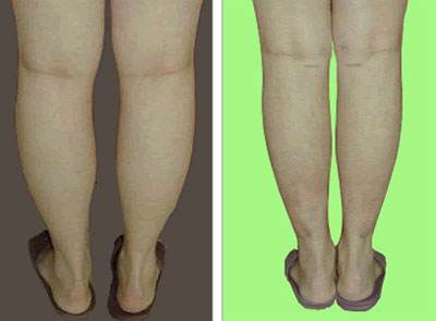 2023深圳熱溶脂減肥醫(yī)生在榜清單top10強(qiáng)(羅雄鵬、易普鋒、張秀麗技術(shù)穩(wěn)定，審美在線，不踩坑！)