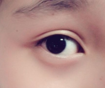 上饒祛眼袋哪家醫(yī)院好？解析上饒地區(qū)的眼袋整形醫(yī)院排名及選擇標(biāo)準(zhǔn)