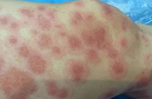 劉春軍豐胸經(jīng)驗(yàn)分享！北京八大處整形外科醫(yī)生解析！