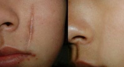 蘭州眼部修復(fù)手術(shù)哪家好？眼部整形專家為您推薦最佳選擇！