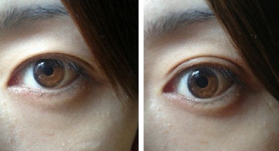 北京開眼角好的醫(yī)院有哪些？