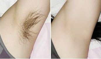 南京面吸哪家醫(yī)院效果好？解讀南京市區(qū)五家口臉部吸脂醫(yī)院的治療效果