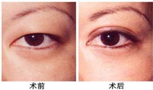 杭州做激光眼科手術(shù)哪家醫(yī)院好，專家推薦