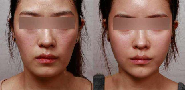 青島水光針推薦醫(yī)院排行榜：哪家醫(yī)院好？