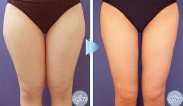 上海光澤醫(yī)院熱瑪吉效果如何？價格是多少？搭配醫(yī)生介紹一起了解