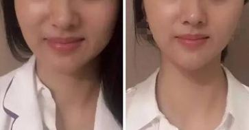 杭州激光祛斑好嗎？哪家激光祛斑的效果好？