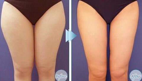 深圳米蘭柏羽雙眼皮效果好嗎？朱武根醫(yī)生值得推薦嗎？院內(nèi)眼部整形特色有哪些？