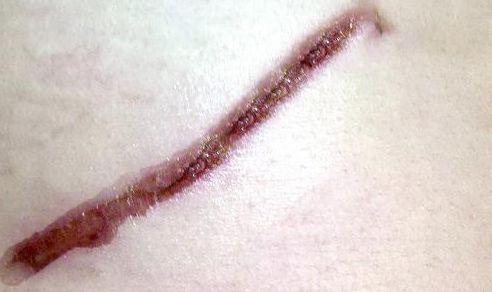 鐳射溶脂杭州哪家醫(yī)院好？專(zhuān)家推薦排名前三的權(quán)威醫(yī)院