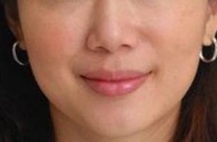 2023昆明射頻去眼底紋大型醫(yī)生(楊順新、李章麗、余海龍這些專家終于入圍了)