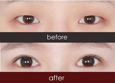 2023泉州抽脂埋線雙眼皮醫(yī)生排名榜前十名(劉劍、李迫達(dá)、王偉韜值得選擇！)