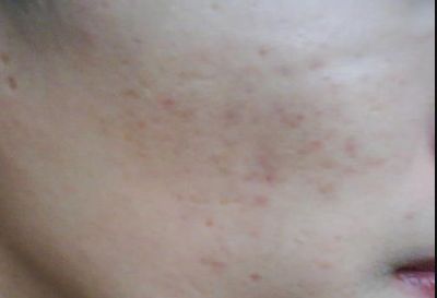 寧波祛疤哪家醫(yī)院哪里好？專家告訴你最佳選擇！