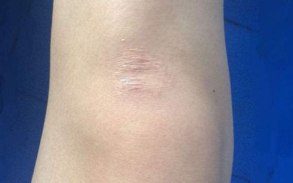 海口超聲去眼袋最佳選擇有哪些？評價最好的醫(yī)療機構(gòu)大揭秘！