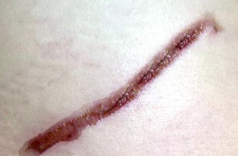 成都去法令紋哪家醫(yī)院好？找到適合你的放心醫(yī)院