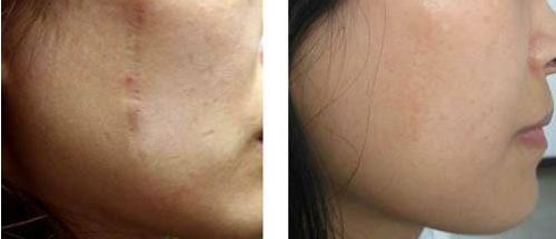 廣州抽脂手術(shù)哪家醫(yī)院最靠譜？