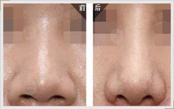 2023鄭州假體隆鼻術(shù)口碑排行前10醫(yī)生(汪金國、尹彩霞、林敬華深得人心！)