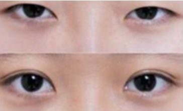 秦皇島雙眼皮哪家做的好？選擇前必看！