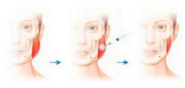 南京假體隆鼻哪家醫(yī)院效果最好？