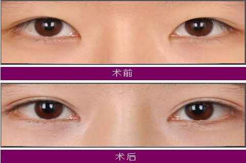 大連注射玻尿酸哪家醫(yī)院技術(shù)好，效果持久？