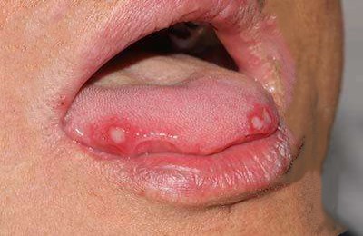 2023清遠(yuǎn)顴骨縮小失敗修復(fù)醫(yī)生強(qiáng)榜前十名(孫森、丘金俊、丘金俊效果自然美觀)