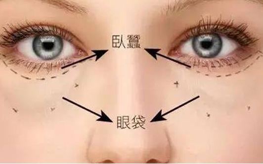 ?？谀募裔t(yī)院做眼袋效果好？