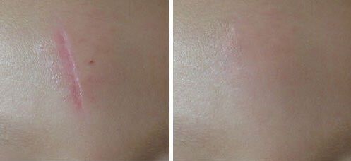 鄭州哪家醫(yī)院激光做的好？找尋專業(yè)！領(lǐng)先的鄭州醫(yī)院激光治療推薦