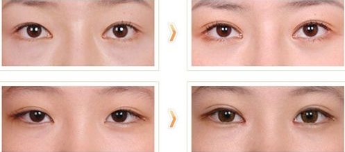 2023南陽眼鼻修復(fù)再造大型專家(陳保國、李穎、黃立新技術(shù)厲害收費還不坑)