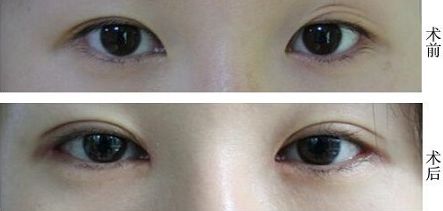 福州抽脂大腿哪家醫(yī)院好？挑選福州最靠譜的抽脂醫(yī)院有哪些？