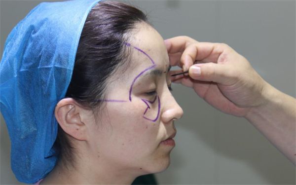 南寧哪家醫(yī)院痘印治療效果最佳？