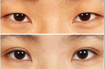 南寧去痘坑哪家醫(yī)院好？揭秘南寧市治療痘坑的頂尖專家團(tuán)隊(duì)！