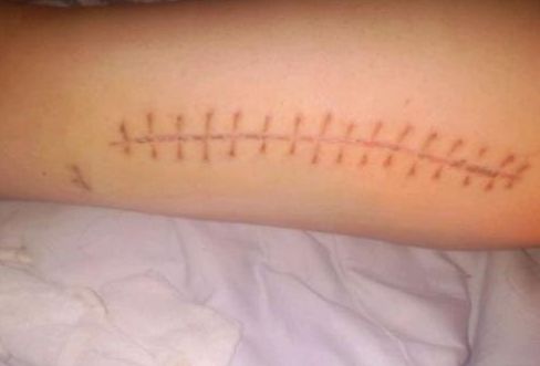 南寧祛除疤痕哪家醫(yī)院比較專業(yè)？