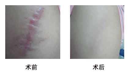 2023寧波口周紋激光去除強(qiáng)榜前10名的醫(yī)生(盧仁鎬、李永俊、陳樂琴正規(guī)良心推薦)