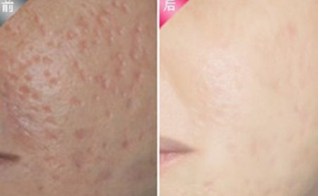 杭州做雙眼皮哪家好？2023年杭州雙眼皮整形醫(yī)院綜合排名指南拆解