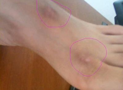 溫州哪家醫(yī)院做雙眼皮手術(shù)好？