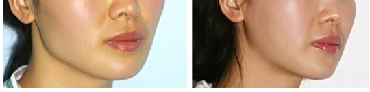 合肥假體隆胸哪家醫(yī)院好？術(shù)后效果如何？