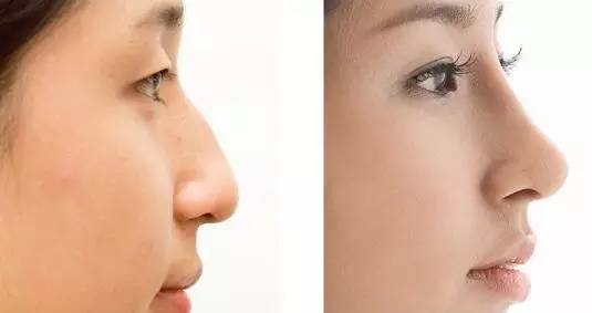 2023宜昌臀部超聲吸脂大型正規(guī)專家(徐漢珍、肖峰、朱遠(yuǎn)平獨(dú)有技術(shù)，效果驚艷眾人！)