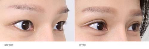 上海整容醫(yī)生推薦：讓您擁有完美鼻型，變身肋骨鼻！