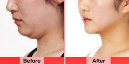 洛陽(yáng)雙眼皮修復(fù)哪家好？挑選專業(yè)技術(shù)實(shí)力強(qiáng)的醫(yī)療機(jī)構(gòu)