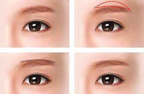 北京馮斌脂肪填充手術(shù)效果分析及相關(guān)費(fèi)用查詢