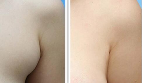 深圳北大何君君墊下巴案例分享，細(xì)節(jié)透露驚艷效果