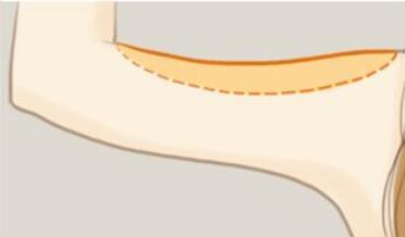 劉金超磨骨手術：專家點評+價格表解析，全面了解醫(yī)生技術及口碑