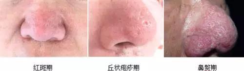 解密楊杰雙眼皮修復失敗案例圖，讓你心中的期望成為現實！