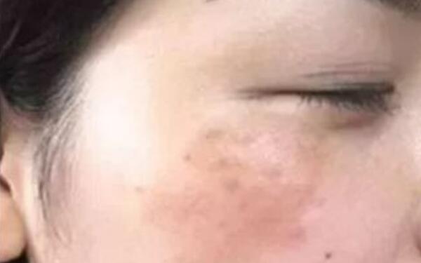 武漢協(xié)和醫(yī)院醫(yī)生鐘愛(ài)梅，精湛鼻子整形案例揭秘